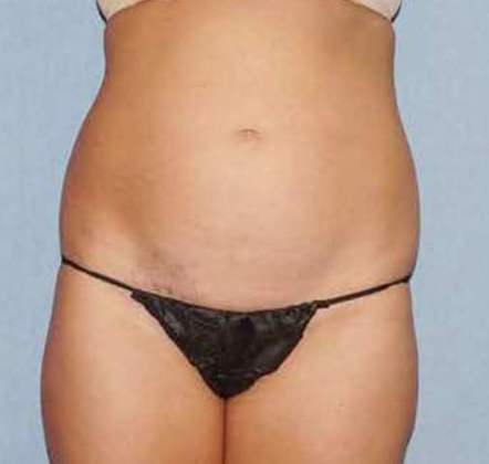 Liposuction Before And After Photo