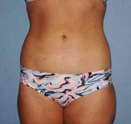 Liposuction Before And After Photo