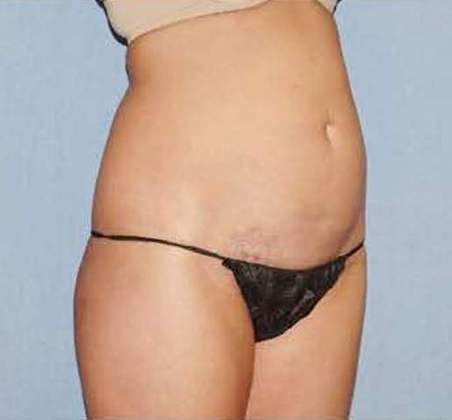 Liposuction Before And After Photo