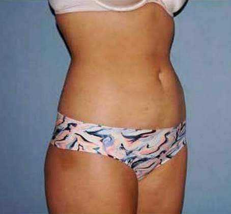 Liposuction Before And After Photo