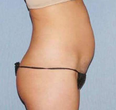 Liposuction Before And After Photo