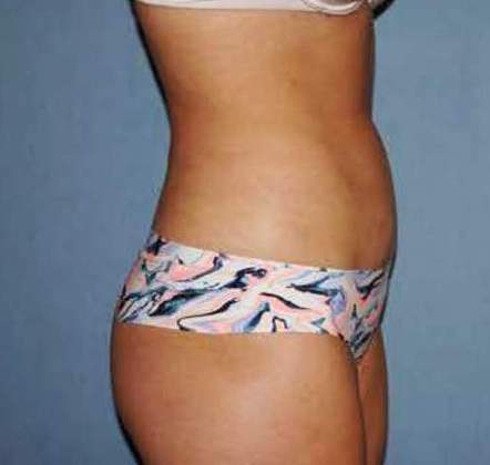 Liposuction Before And After Photo