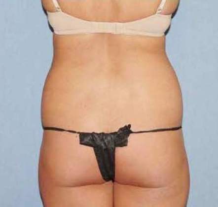 Liposuction Before And After Photo