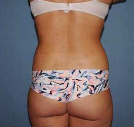 Liposuction Before And After Photo