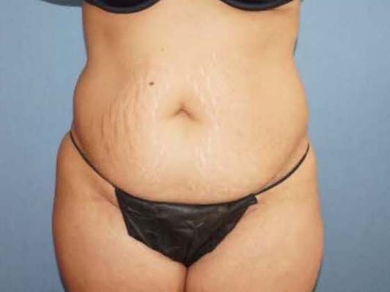 Liposuction Before And After Photo