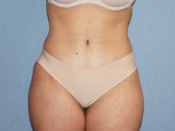 Liposuction Before And After Photo