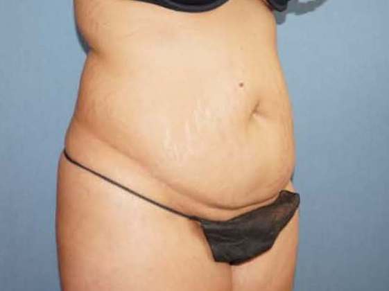 Liposuction Before And After Photo