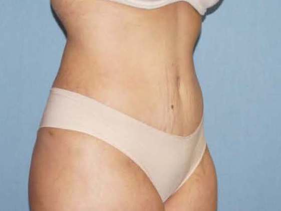 Liposuction Before And After Photo