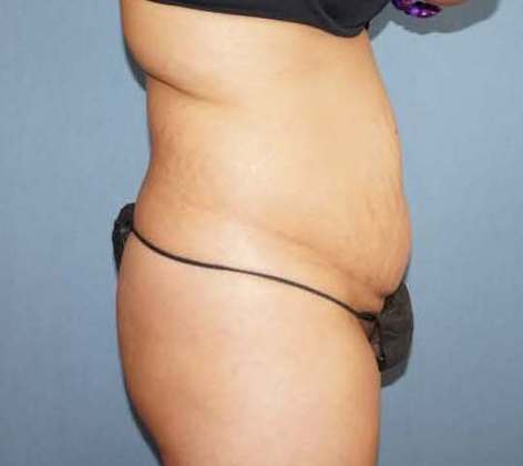 Liposuction Before And After Photo