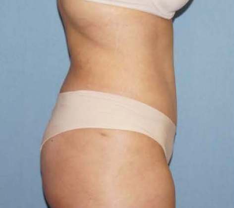 Liposuction Before And After Photo