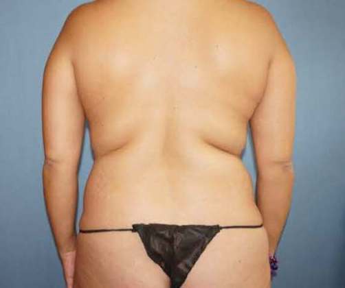 Liposuction Before And After Photo