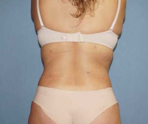 Liposuction Before And After Photo