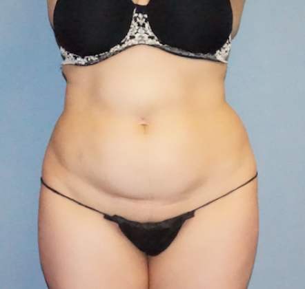 Liposuction Before And After Photo
