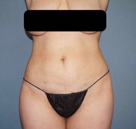 Liposuction Before And After Photo