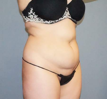 Liposuction Before And After Photo