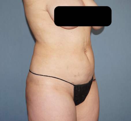 Liposuction Before And After Photo