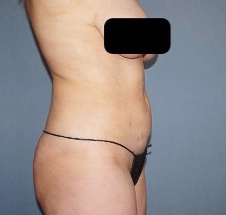 Liposuction Before And After Photo