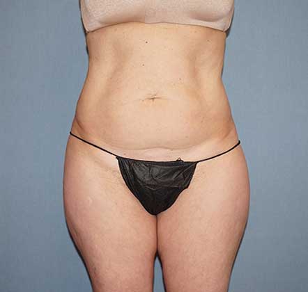 Liposuction Before And After Photo