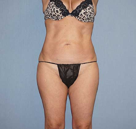 Liposuction Before & After Image