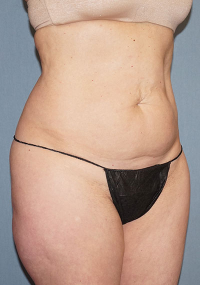 Liposuction Before And After Photo