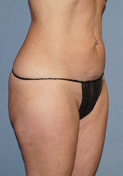 Liposuction Before And After Photo