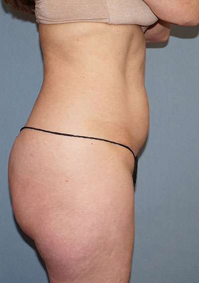 Liposuction Before And After Photo