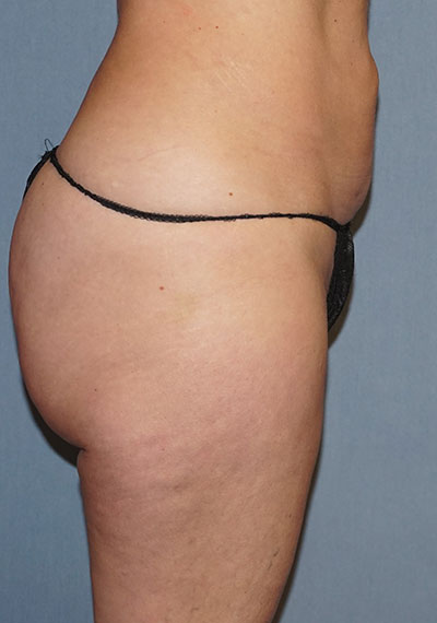 Liposuction Before And After Photo