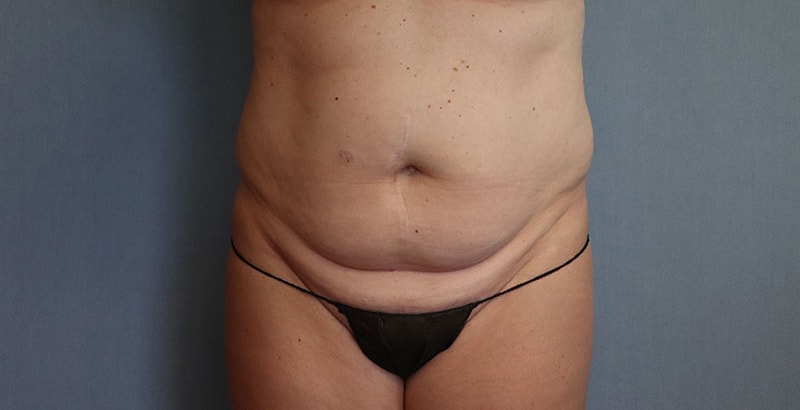 Liposuction Before And After Photo