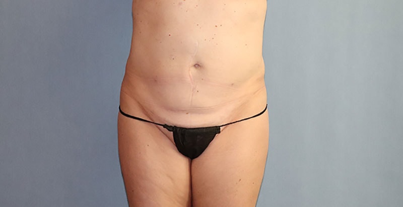 Liposuction Before And After Photo