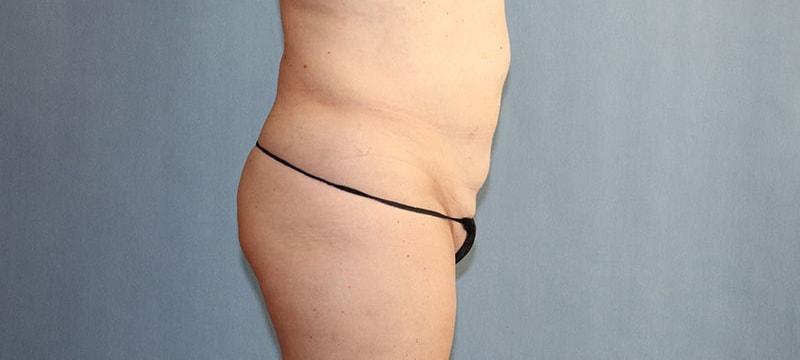 Liposuction Before And After Photo