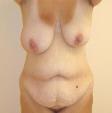 Mommy Makeover Before & After Image