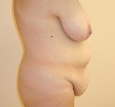 Mommy Makeover Before & After Image