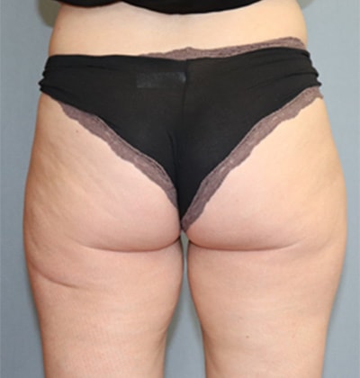 SmartLipo Before And After Photo