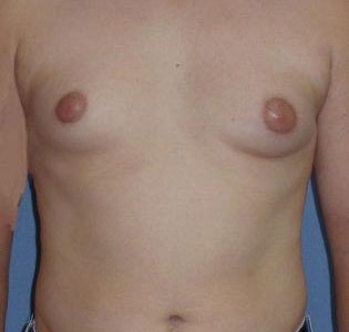 SmartLipo Before And After Photo