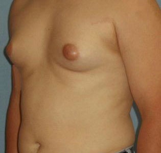 SmartLipo Before And After Photo