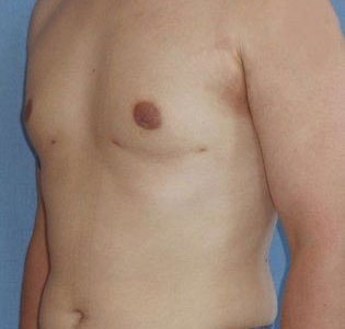 SmartLipo Before And After Photo