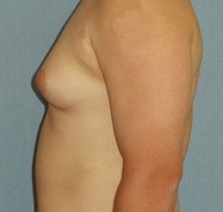 SmartLipo Before And After Photo