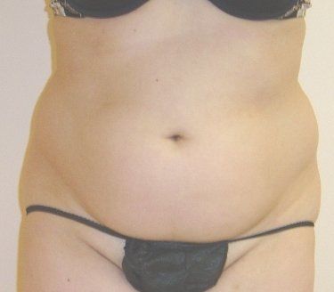 SmartLipo Before And After Photo