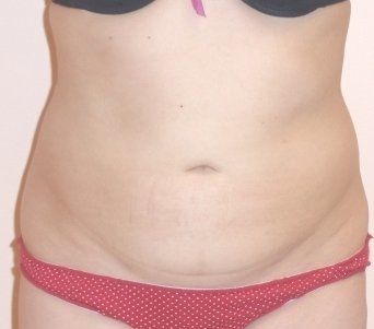 Smartlipo Laser Body Sculpting Before And After Patient 5