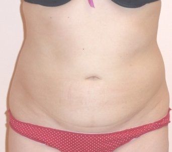 SmartLipo Before And After Photo