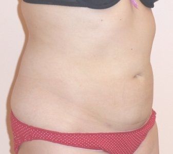 SmartLipo Before And After Photo