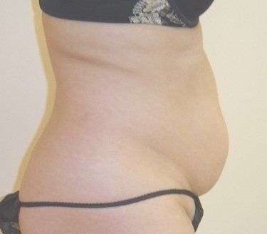 SmartLipo Before And After Photo