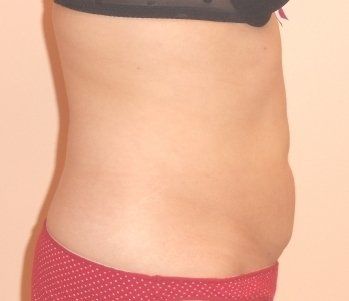 SmartLipo Before And After Photo