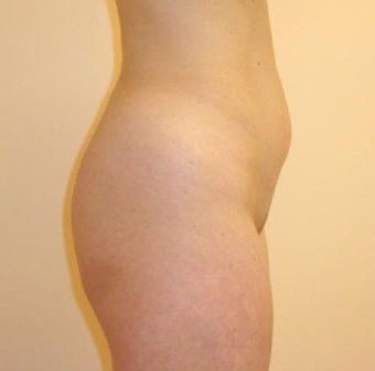 SmartLipo Before And After Photo