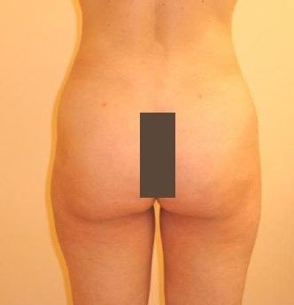 SmartLipo Before And After Photo