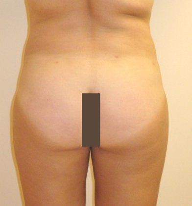 SmartLipo Before And After Photo