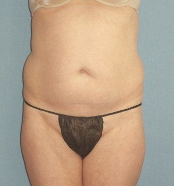 SmartLipo Before And After Photo