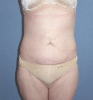 SmartLipo Before And After Photo