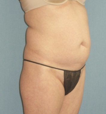 SmartLipo Before And After Photo