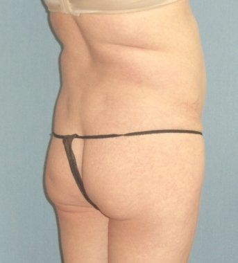 SmartLipo Before And After Photo